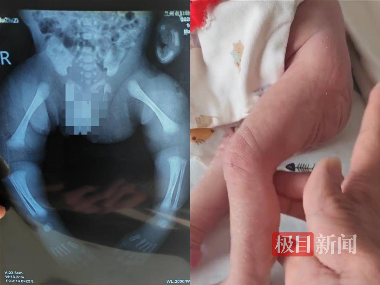 二胎出生查出先天性病症或落下残疾<strong></p>
<p>以太坊最新价格</strong>，残疾父母称医院产检漏检、未尽告知义务，医院及医调委回应