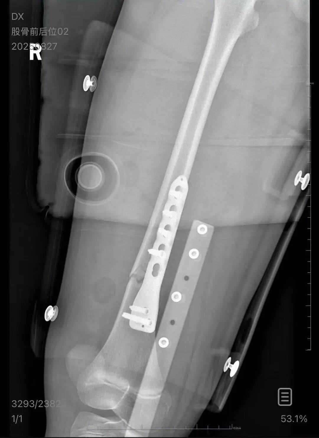 男子火车上铺跌落砸断10岁女孩腿骨<strong></p>
<p>XRP交易所</strong>,回应“失联”称失业讨薪中