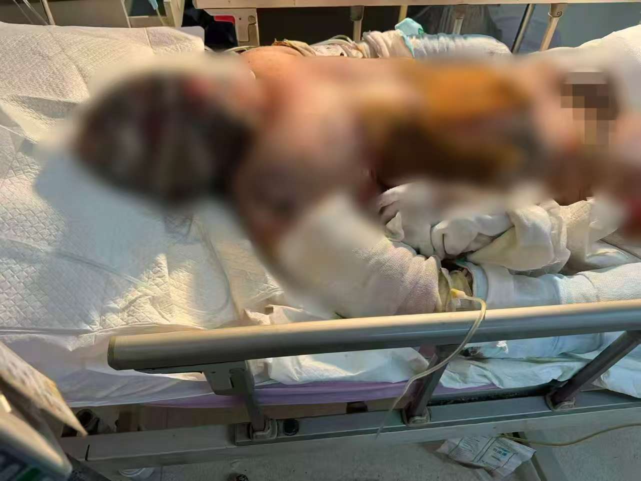 父子在哈尔滨一亲戚公司上班遇爆炸全身烧伤<strong></p>
<p>BNB交易所</strong>，治疗花费近百万公司拒赔偿？亲戚回应