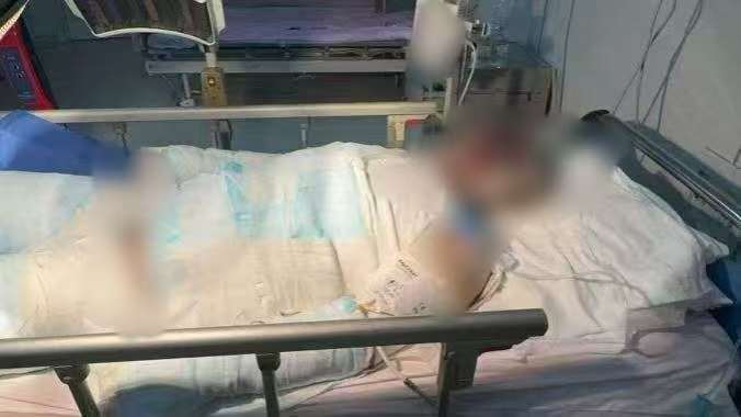 父子在哈尔滨一亲戚公司上班遇爆炸全身烧伤<strong></p>
<p>BNB交易所</strong>，治疗花费近百万公司拒赔偿？亲戚回应