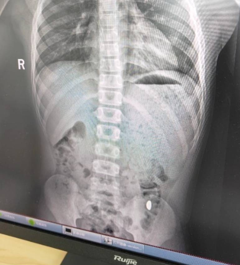 “熊孩子”误吞10克重金豆<strong></p>
<p>绿洲币</strong>,妈妈:天天叮嘱他不要在外面拉屎