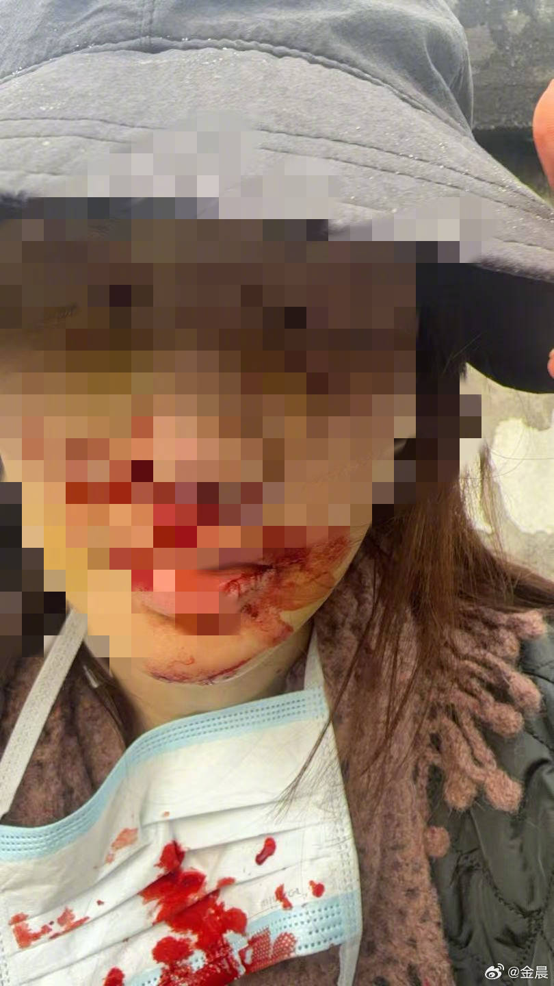 警方发布警情通报后<strong></p>
<p>币圈徐可</strong>，金晨晒脸部受伤照片并发文道歉