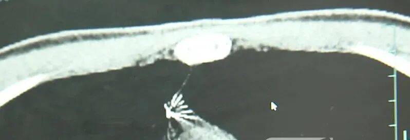 17岁小伙参军体检发现胸腔内有根5cm缝衣针<strong></p>
<p>古德币</strong>,父母回忆或是1岁时扎入,取出时已锈迹斑斑