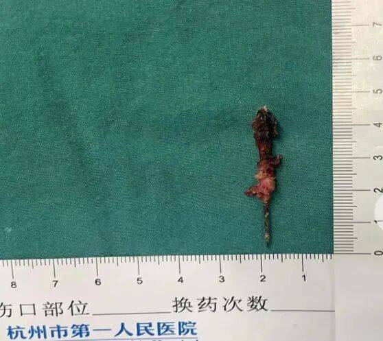 17岁小伙参军体检发现胸腔内有根5cm缝衣针<strong></p>
<p>古德币</strong>,父母回忆或是1岁时扎入,取出时已锈迹斑斑