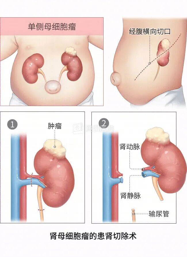 “感觉天塌了”！深圳女孩5岁患癌<strong></p>
<p>雷速币</strong>，爸妈决定：为她冻存卵巢组织