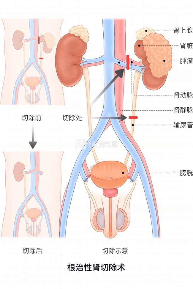 “感觉天塌了”！深圳女孩5岁患癌<strong></p>
<p>雷速币</strong>，爸妈决定：为她冻存卵巢组织